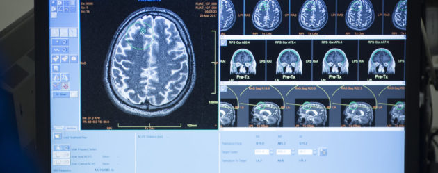 Alzheimer: un mythe à bout de souffle?