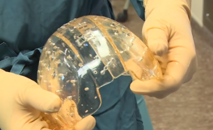 Un crâne imprimé en 3D implanté avec succès