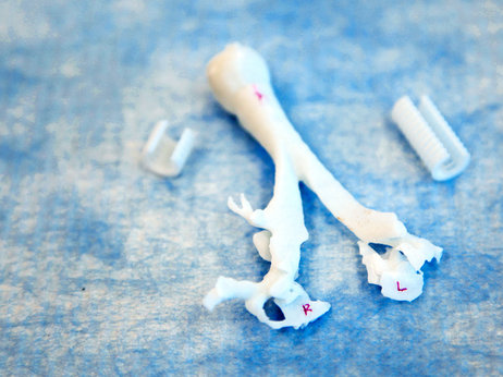 Doctors use 3-D printing to help a baby breathe