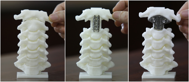 3D-printed vertebra used in spine surgery