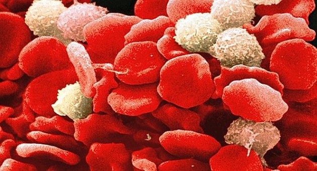 Innovative Therapie einer bösartigen Blutstammzell-Erkrankung