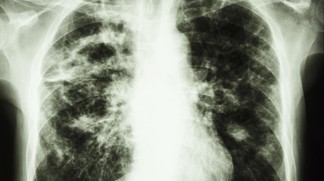 De nouvelles armes contre la tuberculose multirésistante…