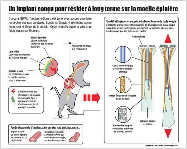 Paralysie: l’implant qui se greffe sur la moelle épinière