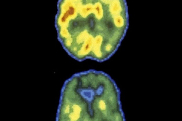 L’inflammation du cerveau cause-t-elle la dépression?