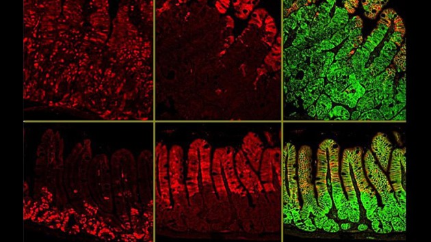 Traiter le cancer du colon avec la vitamine A