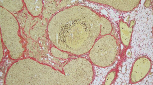 Faire « survivre » un cancer du sein pour mieux le combattre