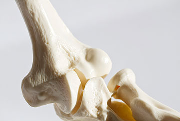 De nouvelles pistes de traitement contre l’ostéoporose