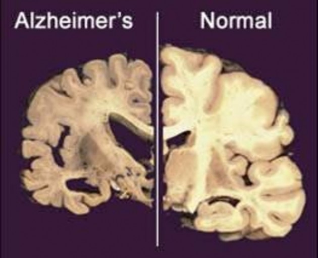 Nanoparticules nocives retrouvées dans le cerveau