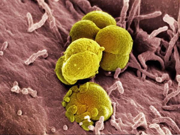 Gonorrhée résistante aux antibiotiques : Debiopharm décroche une bourse