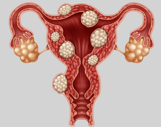 Debiopharm et Dexa Medica collaborent au lancement de triptoréline pour donner un nouvel espoir aux femmes atteintes d’endometriose