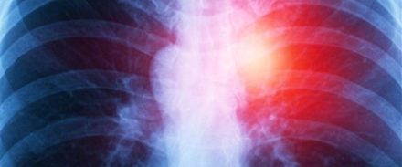 L’IA et la technologie “organ-on-chip” pour détecter tôt les métastases pulmonaires
