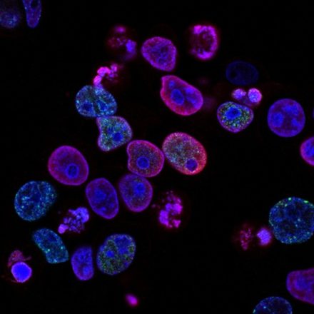 La Suisse lance un projet IA pour renforcer l’oncologie de précision