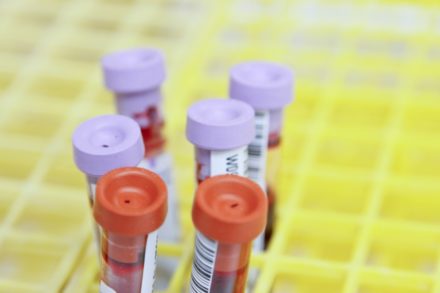 Un simple test sanguin bientôt testé au Royaume Uni pour mieux diagnostiquer Alzheimer