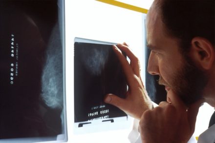 La metformine augmente un métabolite lié aux bénéfices de l’exercice chez des patients atteints d’un cancer de la prostate