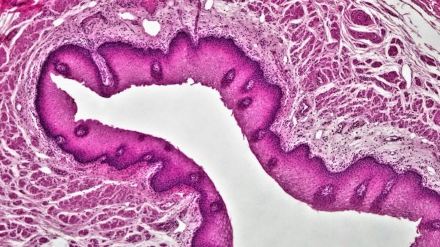 Un traitement ciblant RAS double la survie dans un cancer du pancréas avancé