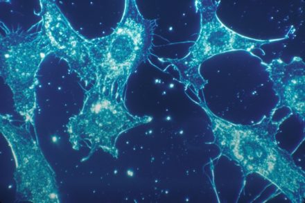 Un biomarqueur sanguin pourrait mieux prédire la progression de la sclérose en plaques