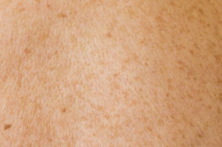 Un vaccin à ARN messager contre le mélanome franchit une étape clé