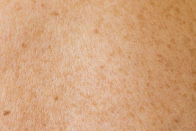 Un vaccin à ARN messager contre le mélanome franchit une étape clé