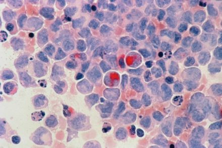 De nouvelles molécules pourraient réveiller l’immunité contre les tumeurs résistantes