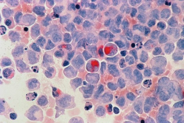 De nouvelles molécules pourraient réveiller l’immunité contre les tumeurs résistantes