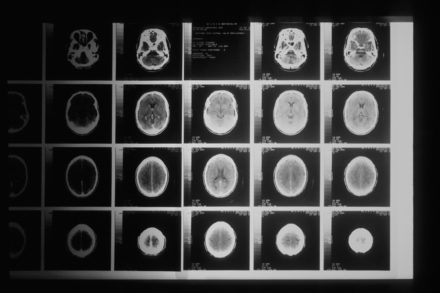 Cancer du cerveau : l’immunothérapie avant la chirurgie pourrait changer la donne